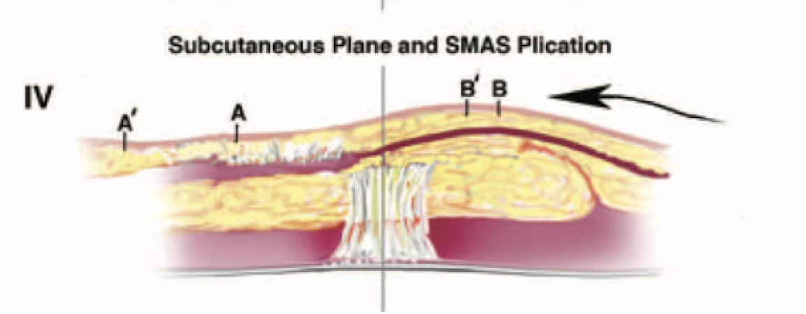 皮下を剥離しSMAS表面から縫縮するSMAS plicationの模式図