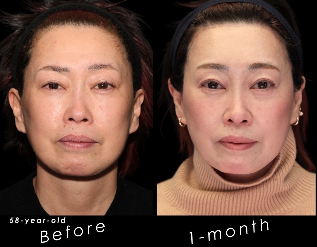 58歳女性の前額リフトと筋肉処理症例。左が術前、右が術後1か月